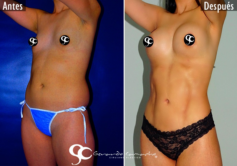 Testimonio Lipoescultura Bogota